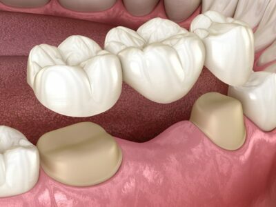 What Are the Health Benefits of Dental Bridges in New York? Dental Bridges