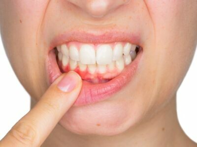 Gum Disease Affects More Than Just Your Oral Health! Gum Disease