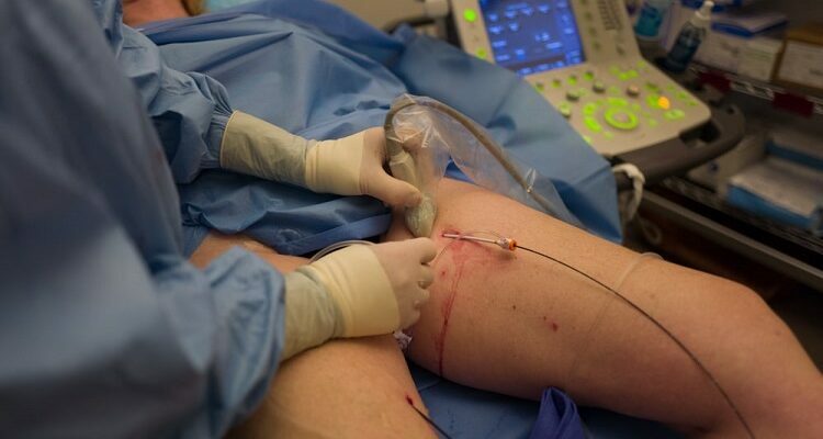 Vein Ablation