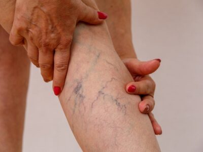 Venous Ulcers