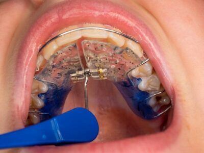 How to Cope up With Expanders orthodontic expanders