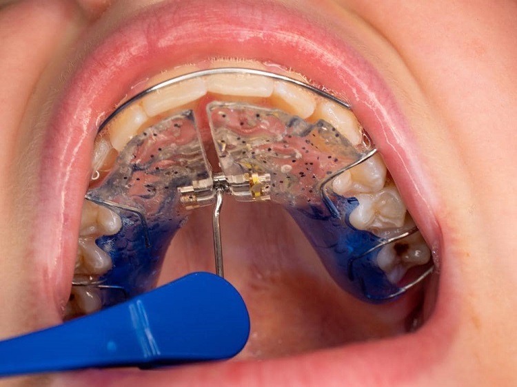 First Aid Expander How To Cope Up With Expanders