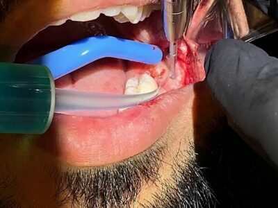 Wisdom Tooth Removal