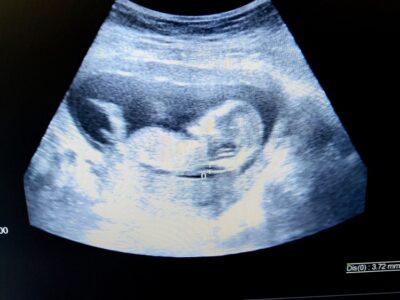 Nuchal Translucency