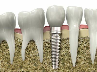 Missing Teeth