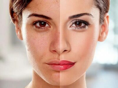 Whitening Dark Spots