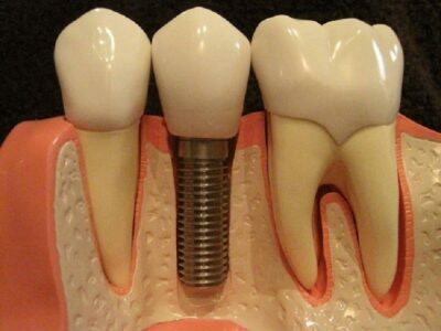 Are There Any Side Effects with Dental Implants? Dental