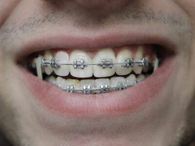 eeth Without Braces