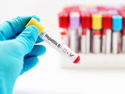 Hepatitis B